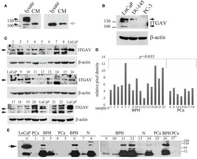 Integrin Alpha V in Urine: A Novel Noninvasive Marker for Prostate Cancer Detection